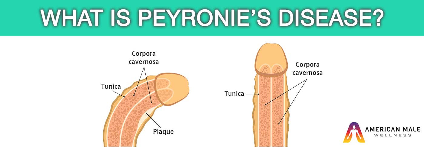 What-is-Peyronies-Disease?